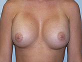 Patient # 47207 After Photo # 2
